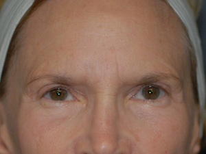 Before Brow Lift