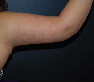 Arm Lift After Photo by Steely Plastic Surgery in Houston, TX