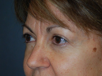 After Augmentation