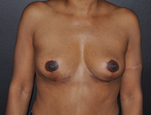Breast Implant Removal After