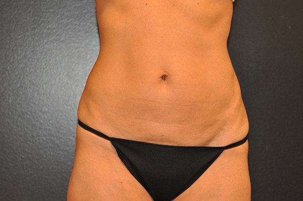 Mini Tummy Tuck Before and After Photo by Dr. Steely in Houston, TX