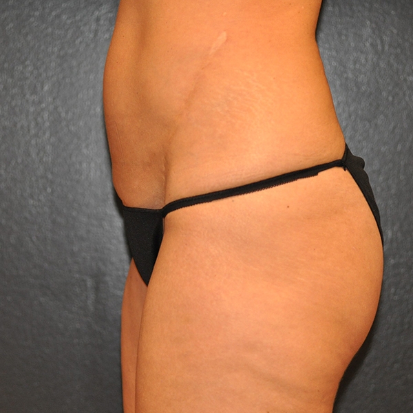 Mini Tummy Tuck Before and After Photo by Dr. Steely in Houston, TX
