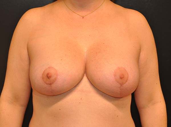 Breast Lift with Impants Before and After Photo by Dr. Steely in Houston, TX