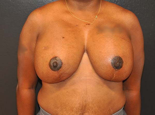 Breast Lift with Impants Before and After Photo by Dr. Steely in Houston, TX