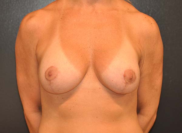 Breast Lift with Impants Before and After Photo by Dr. Steely in Houston, TX