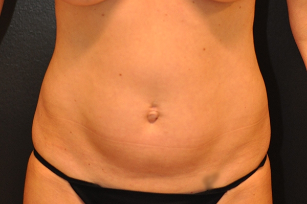 Mini Tummy Tuck Before and After Photo by Dr. Steely in Houston, TX
